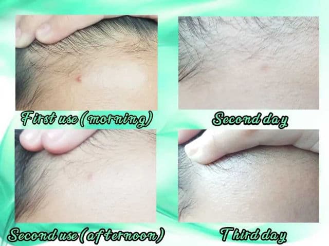 Beplain Cicaterol Moisturizer review photo by Pattypan