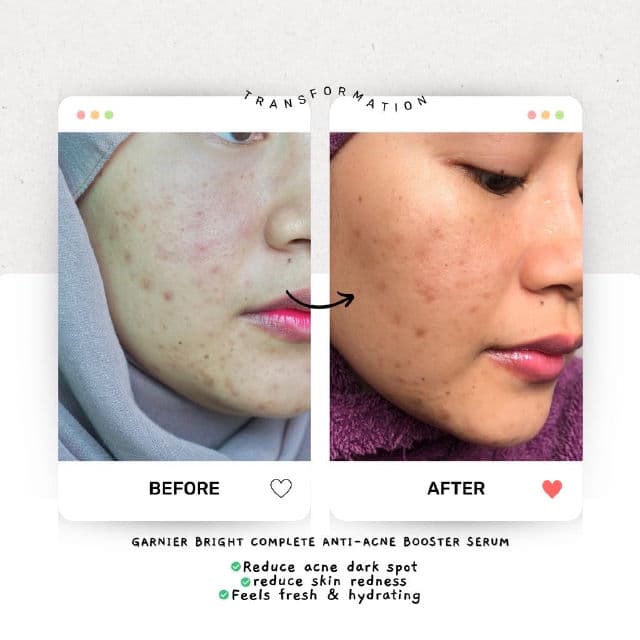 Garnier Bright Complete Anti-Acne Booster Serum review photo by athirahlani