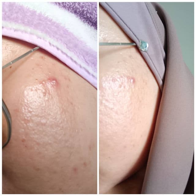 Healez SOS Acne Spot Gel review photo by Jamalia