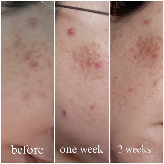 The Pastels Shop "SA" 2% Salicylic Acid Serum review photo by Jamalia