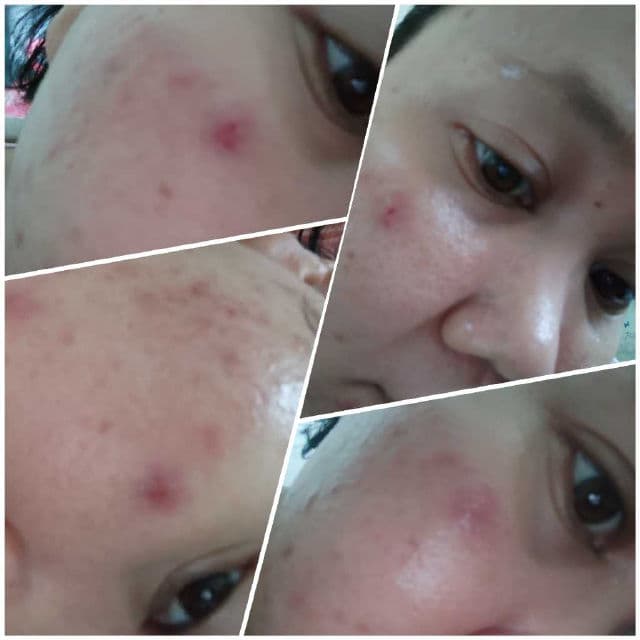 Daughters of Malaya Sulfur Spot Drying Lotion review photo by Jamalia