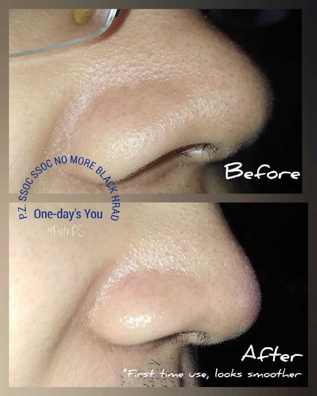 One-day's you P.Z. Ssoc Ssoc No More Blackhead review photo by lilprincess