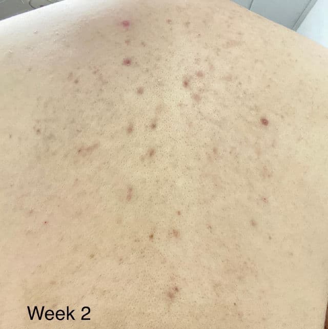 TIAM Anti Blemish Body Lotion Back & Chest review photo by Sushen