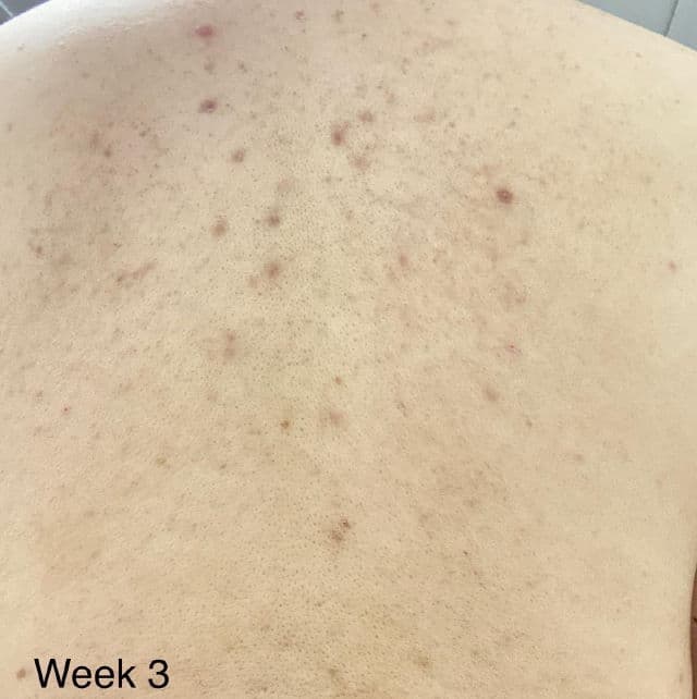 TIAM Anti Blemish Body Lotion Back & Chest review photo by Sushen