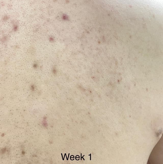 TIAM Anti Blemish Body Lotion Back & Chest review photo by Sushen