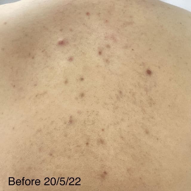 TIAM Anti Blemish Body Lotion Back & Chest review photo by Sushen