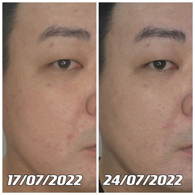 Alpha Arbutin Cream for Brightening product review