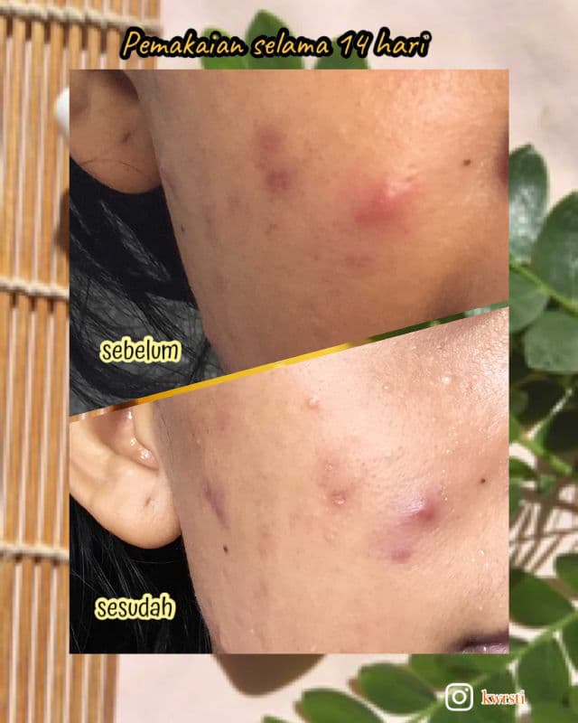 Innertrue Focus Vitamin C 10% + Peptide 1% Ampoule review photo by Kalpika