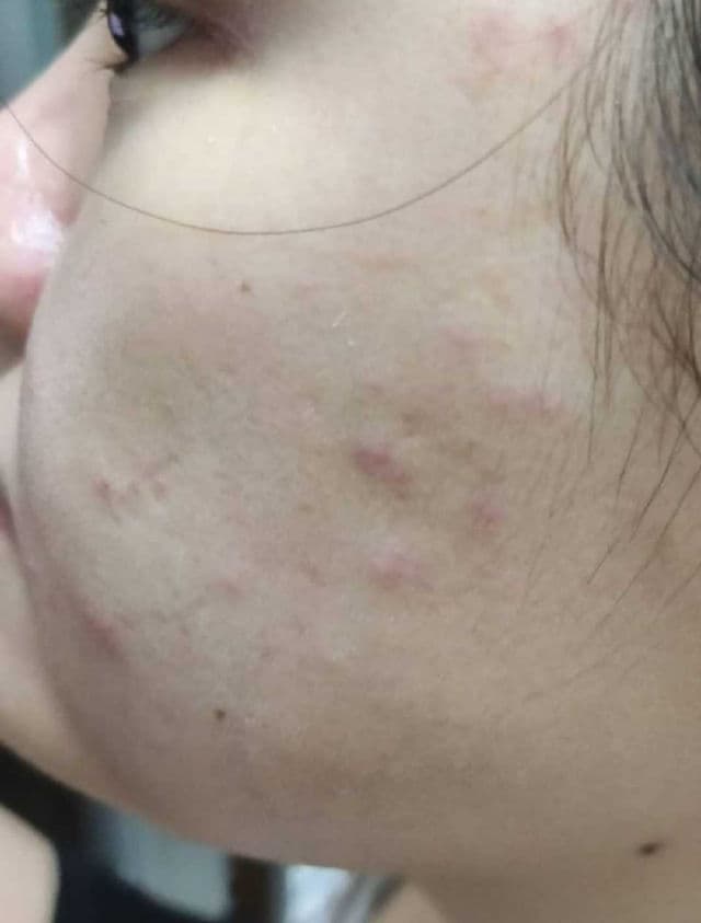 Derm10 Mediclear Comedone Complex review photo by maypiing