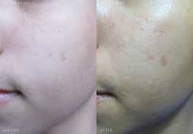 Hada Labo Haruhada Exfoliating Lotion review photo by WondaDonda