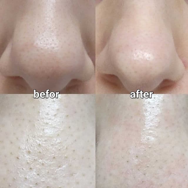 CNP Laboratory Anti-Pore Blackhead Clear Kit - Mask 2: Pore Tightening Mask review photo by MoranG