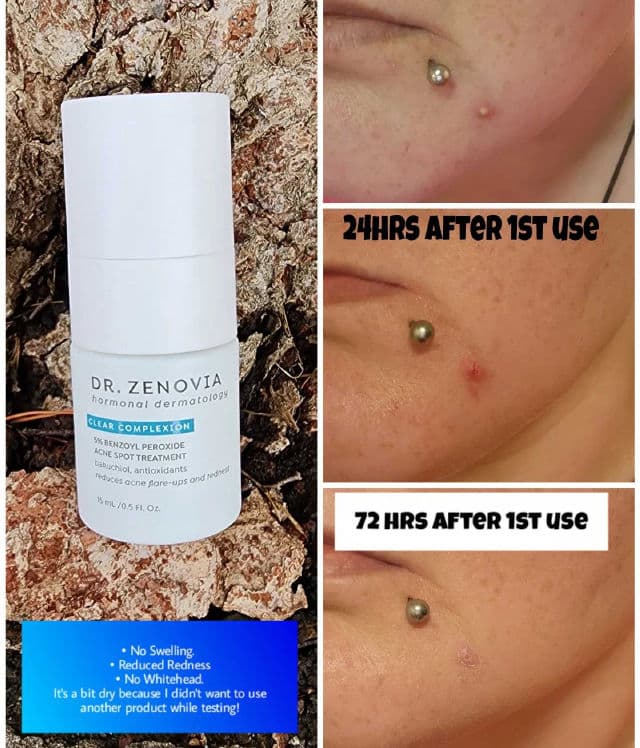 Dr. Zenovia 5% Benzoyl Peroxide Acne Spot Treatment review photo by Researching4Beauty