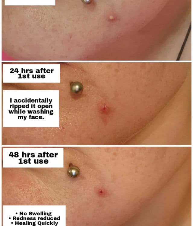 Dr. Zenovia 5% Benzoyl Peroxide Acne Spot Treatment review photo by Researching4Beauty