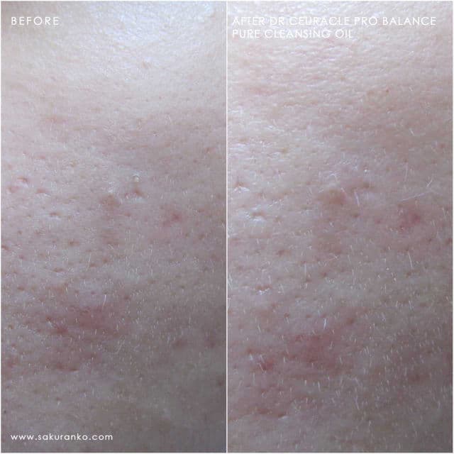 Dr. Ceuracle Pro Balance Pure Cleansing Oil review photo by Sakuranko