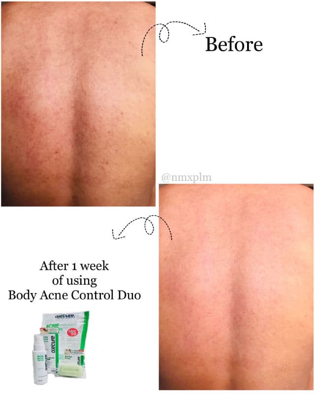 Oxecure Acne Spray review photo by nmxplm