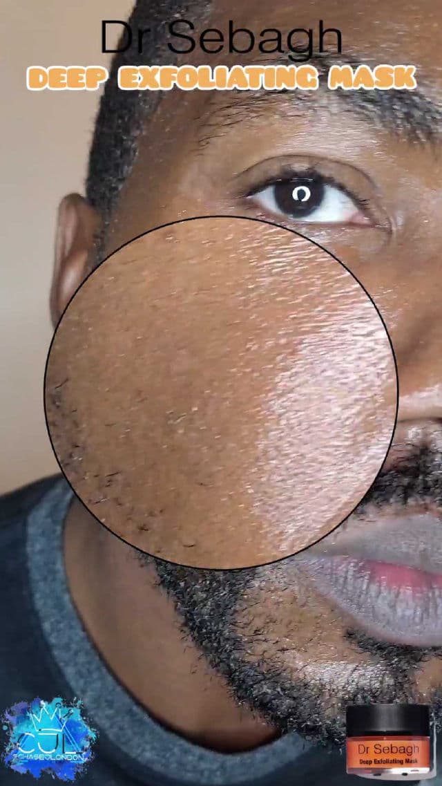 Dr. Sebagh Deep Exfoliating Mask review photo by CHASEJLONDON