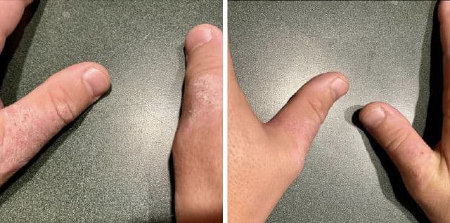 Evereden Healing Eczema Treatment review photo by IowaBeautyLover