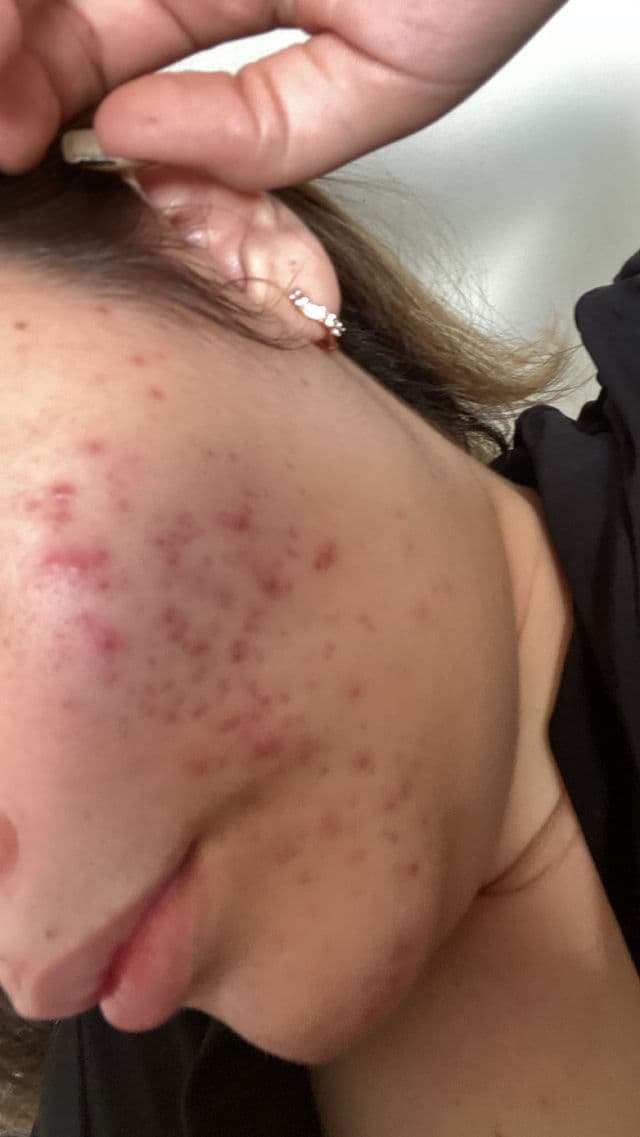 Nacific Origin Red Salicylic Acid Serum review photo by Ellizatorre