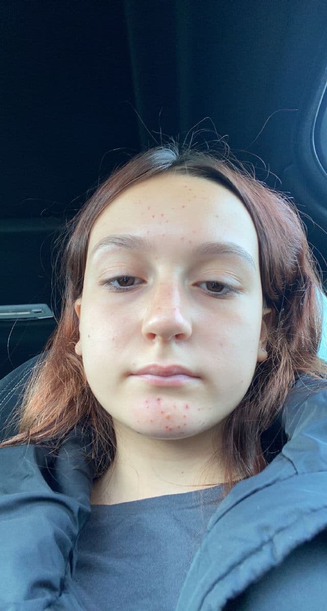 Clinique Anti-Blemish Solutions™ Clinical Clearing Gel review photo by Alexazx