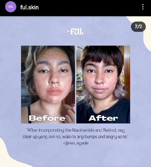 +ful Retinol 1% Serum (Anti-Aging Treatment)	 review photo by Renegade