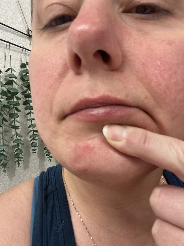 Deep Blemish Microdarts product review