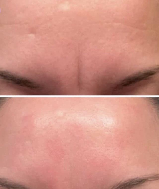 Frownies Wrinkle Patches for Forehead & Between Eyes review photo by IndiGirlReviews