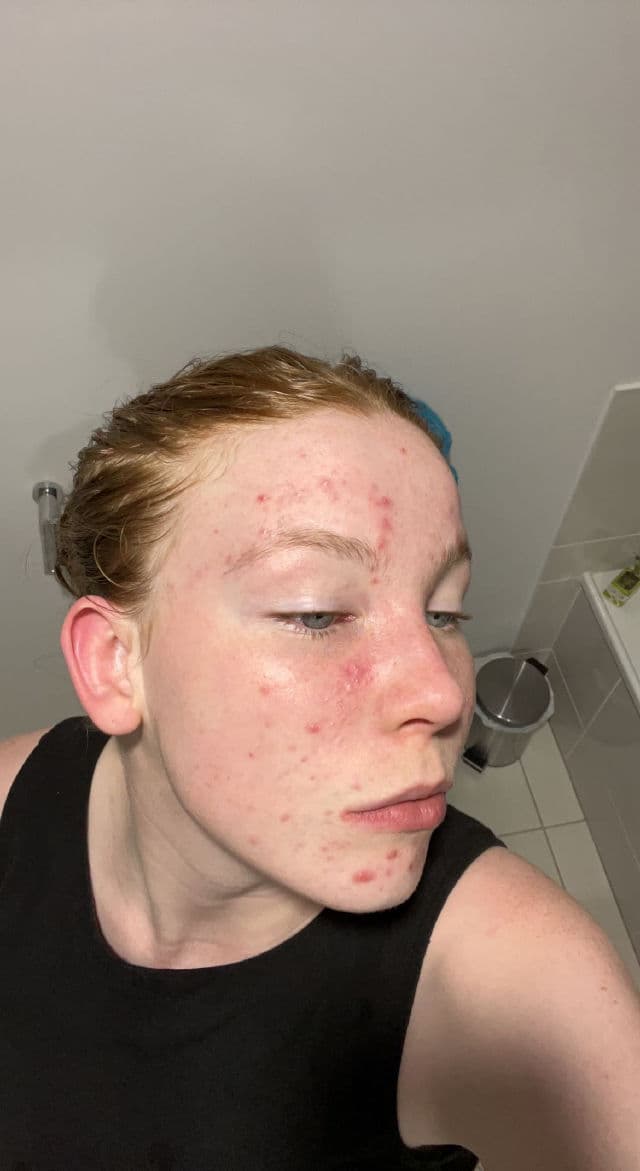 Hero Cosmetics Clarifying Prebiotic Moisturizer review photo by Lizzieeeee