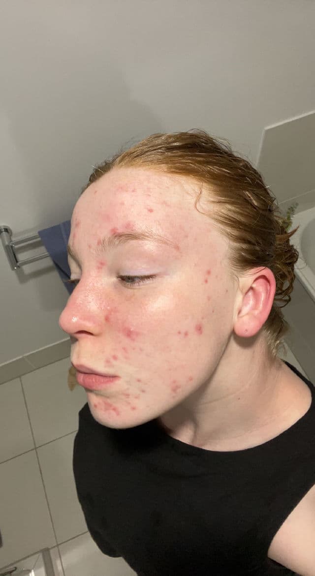 Hero Cosmetics Clarifying Prebiotic Moisturizer review photo by Lizzieeeee