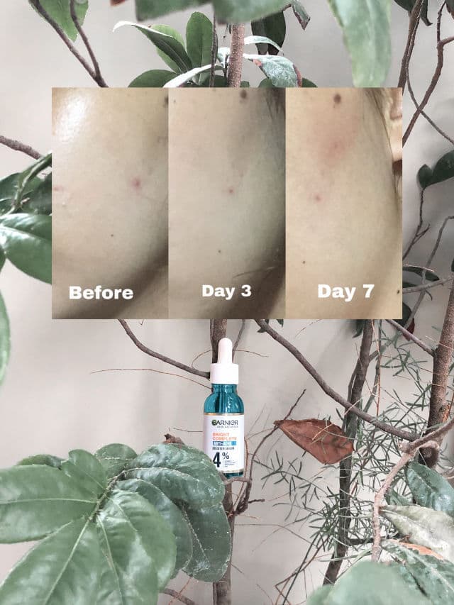 Garnier Bright Complete Anti-Acne Booster Serum review photo by thenicolejapa