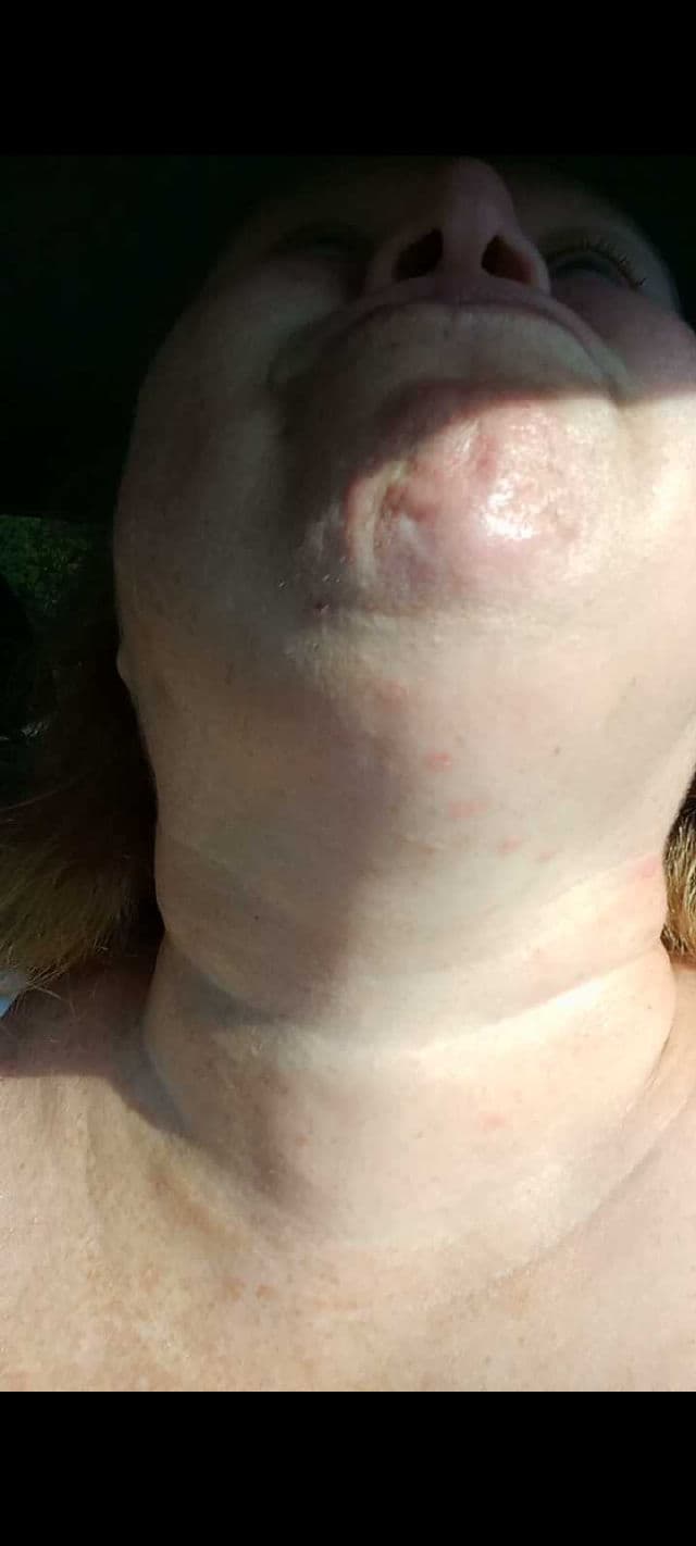 No7 Acne Treatment 2% Salicylic Acid review photo by DiscoveringDaily