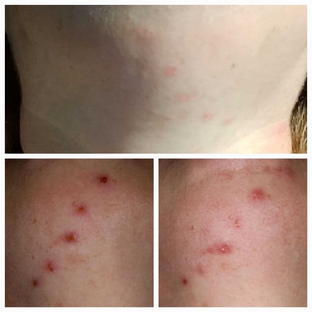 No7 Acne Treatment 2% Salicylic Acid review photo by DiscoveringDaily