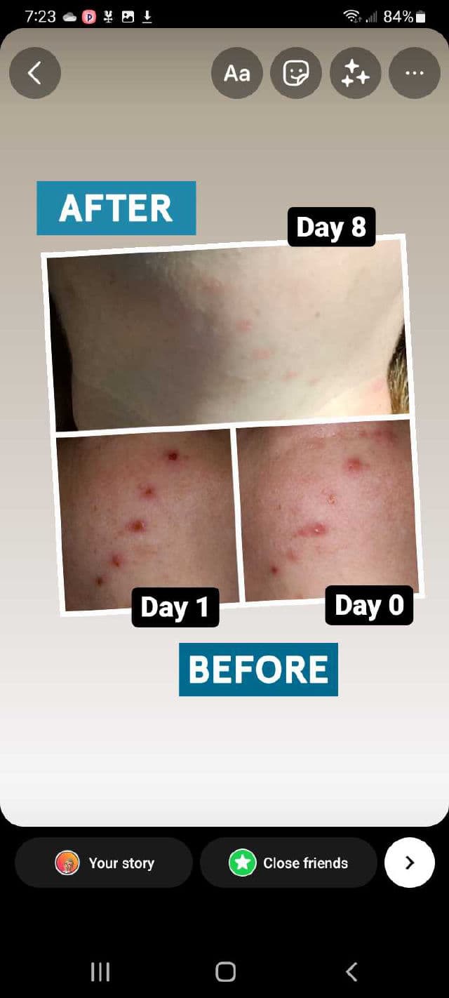 No7 Acne Treatment 2% Salicylic Acid review photo by DiscoveringDaily