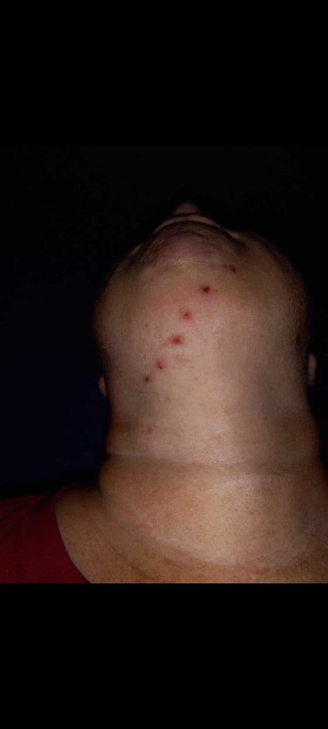 No7 Acne Treatment 2% Salicylic Acid review photo by DiscoveringDaily