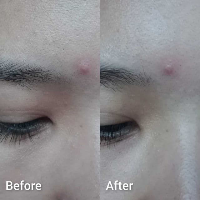 Hero Cosmetics Mighty Patch Micropoint for Blemishes review photo by papillonskin