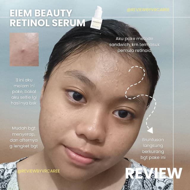 Eiem Beauty Baby Face Acne Free Serum, Retinol 1.5% Actosome review photo by llaviraa