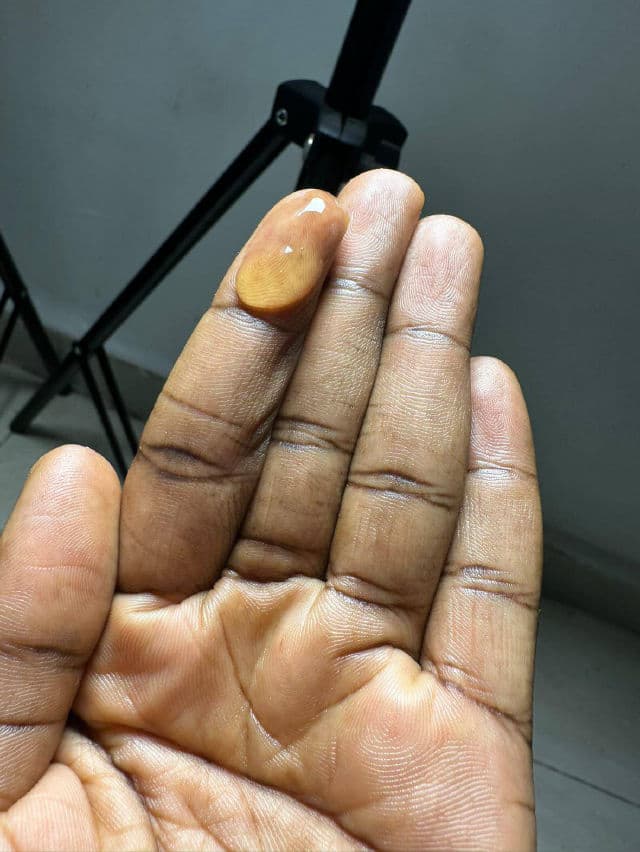 Menarini Tretinoin Gel USP A-Ret 0.1% review photo by thehempresshesed