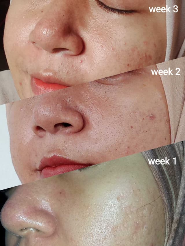 ElsheSkin Hydra Boost Oil Free Moisturizer review photo by uelfani