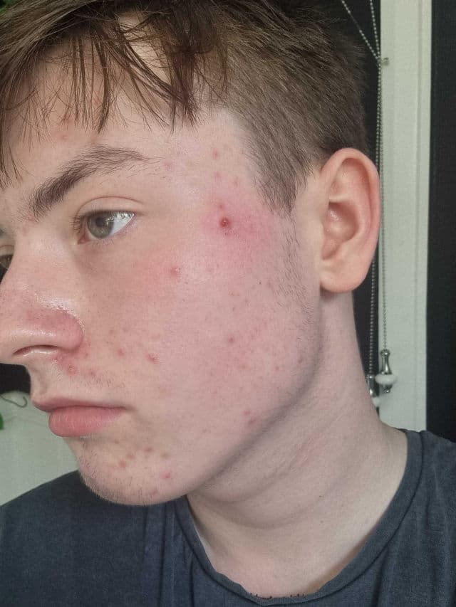 Garnier 3.5% Vitamin C, Niacinamide, Salicylic Acid, Brightening & Anti Dark Spot Serum review photo by Aidenpkb