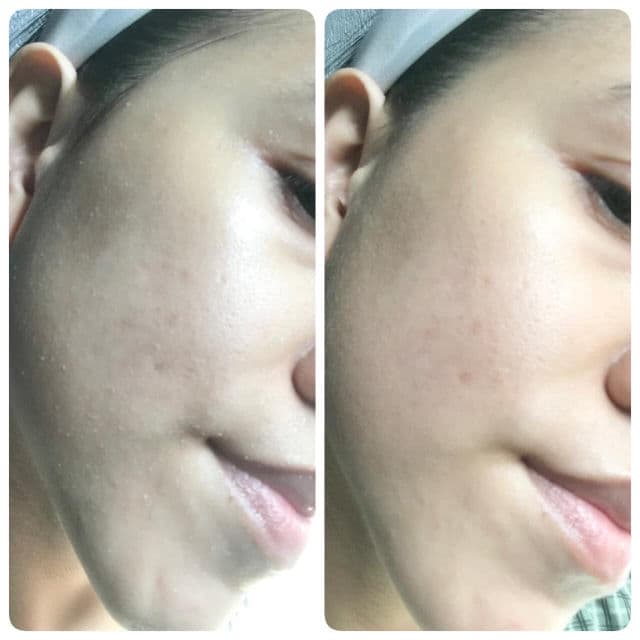 Bioderma Sebium Exfoliating Gel review photo by thihoang