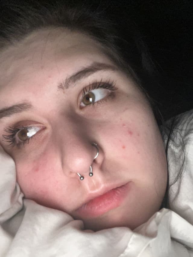 Murad Rapid Relief Acne Spot Treatment review photo by laurendorseyy