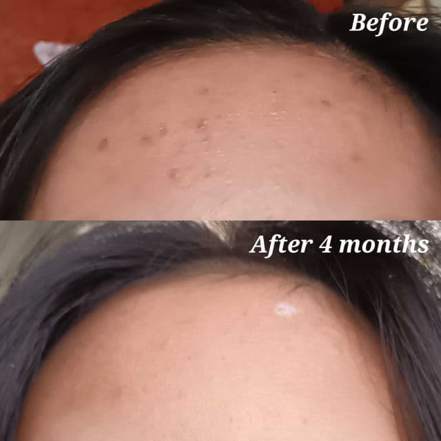 Dermorepubliq 10% Niacinamide + Hyaluronic Acid Face Anti-Blemish Serum review photo by Avrelayne