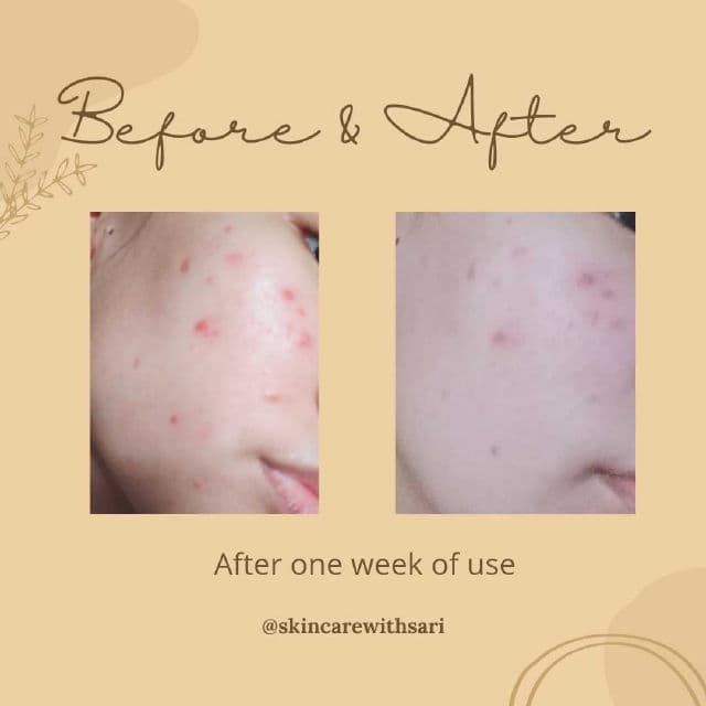 QUICK FX Pimple Eraser Soothing Gel review photo by SkincareWithSari