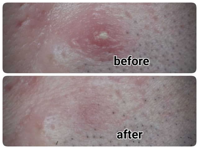 Thursday Plantation Tea Tree Blemish Gel review photo by unclelovesbeauty