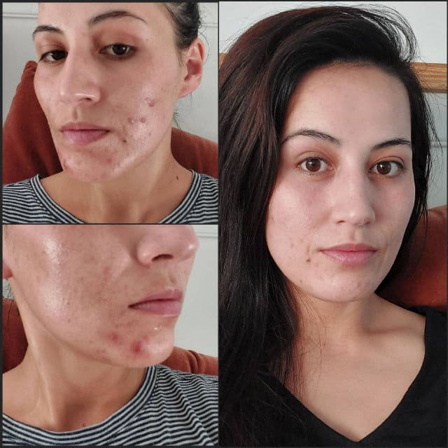 Stiefel Stieva-A 0.05% review photo by ceerenee