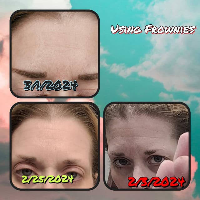 Frownies Wrinkle Patches for Forehead & Between Eyes review photo by Rockinmomlife