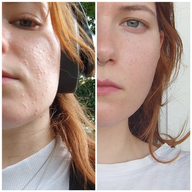 The Inkey List Redness Relief Solution with 10% Azelaic Acid Serum review photo by BicepSoup
