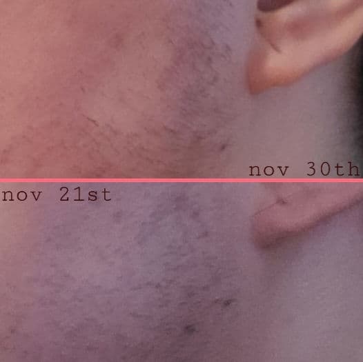 The Ordinary Azelaic Acid Suspension 10% review photo by pavementflower