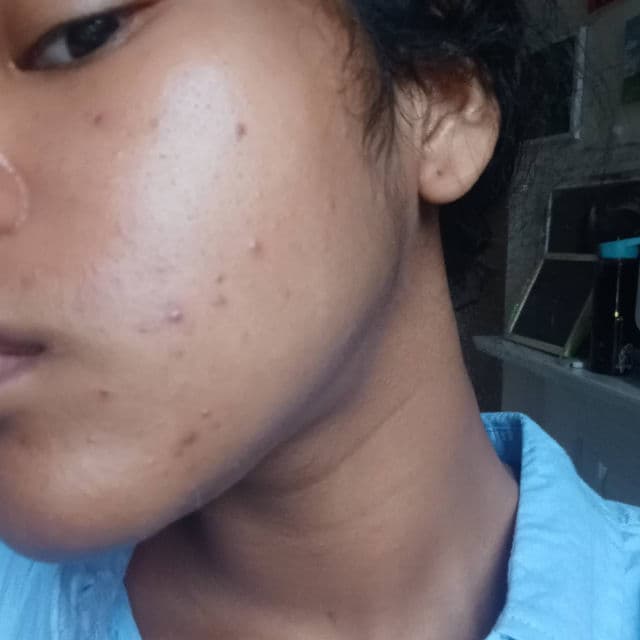 Some By Mi AHA BHA PHA 30 Days Miracle Toner review photo by maayland