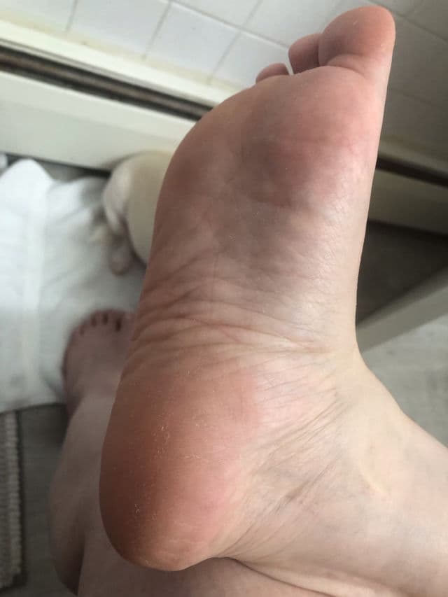 Baren Callus Remover Kit for Feet: Foot File & Peeling Foot Spray review photo by Esther0316