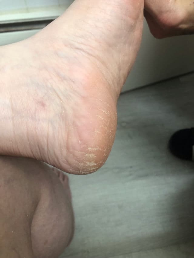 Baren Callus Remover Kit for Feet: Foot File & Peeling Foot Spray review photo by Esther0316